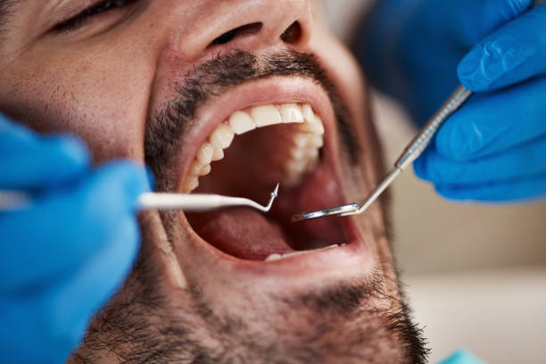 Best Emergency Dental Care for Broken or Chipped Teeth in Carthage, TX