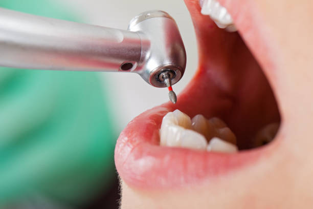 Best Emergency Treatment for Dental Infections or Abscesses in Carthage, TX